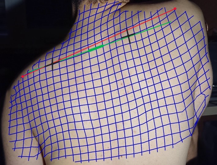 Tracked back-skin points illustrating alternative marker locations
